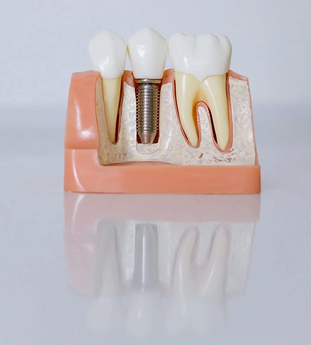 Zahnimplante vom Implantologen Frankfurt